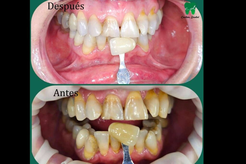 La importancia de una sonrisa radiante; Blanqueamiento dental en dos citas
