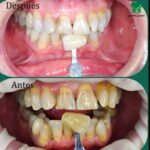 La importancia de una sonrisa radiante; Blanqueamiento dental en dos citas