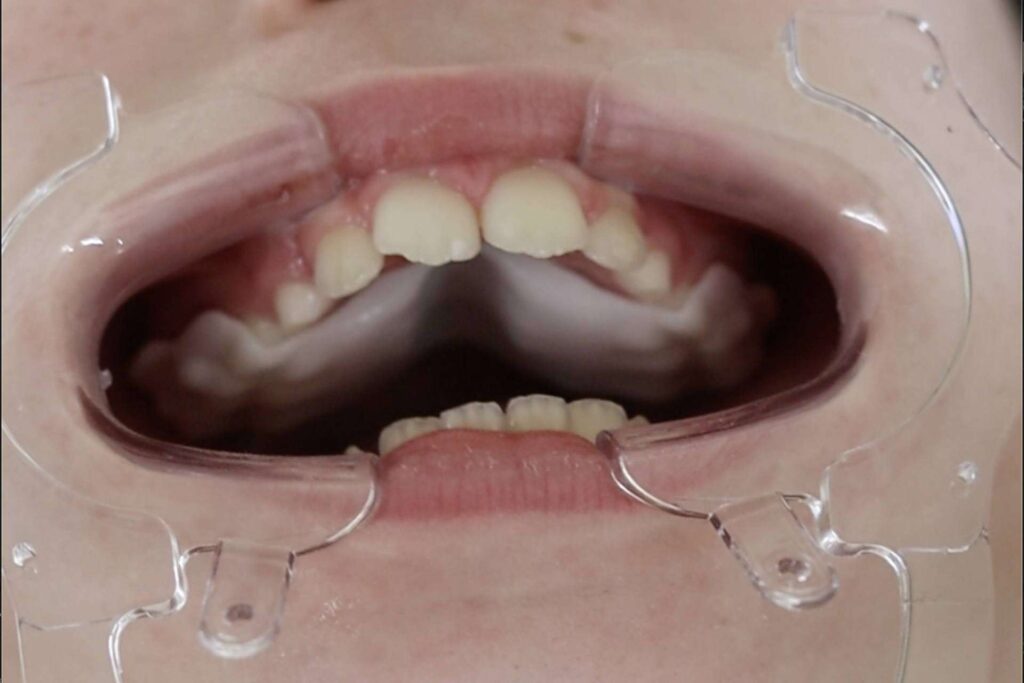 Smart Aligner Services da la bienvenida al Palatal Expander en su evento ‘Expansión Dental y esquelética’