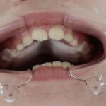 Smart Aligner Services da la bienvenida al Palatal Expander en su evento ‘Expansión Dental y esquelética’