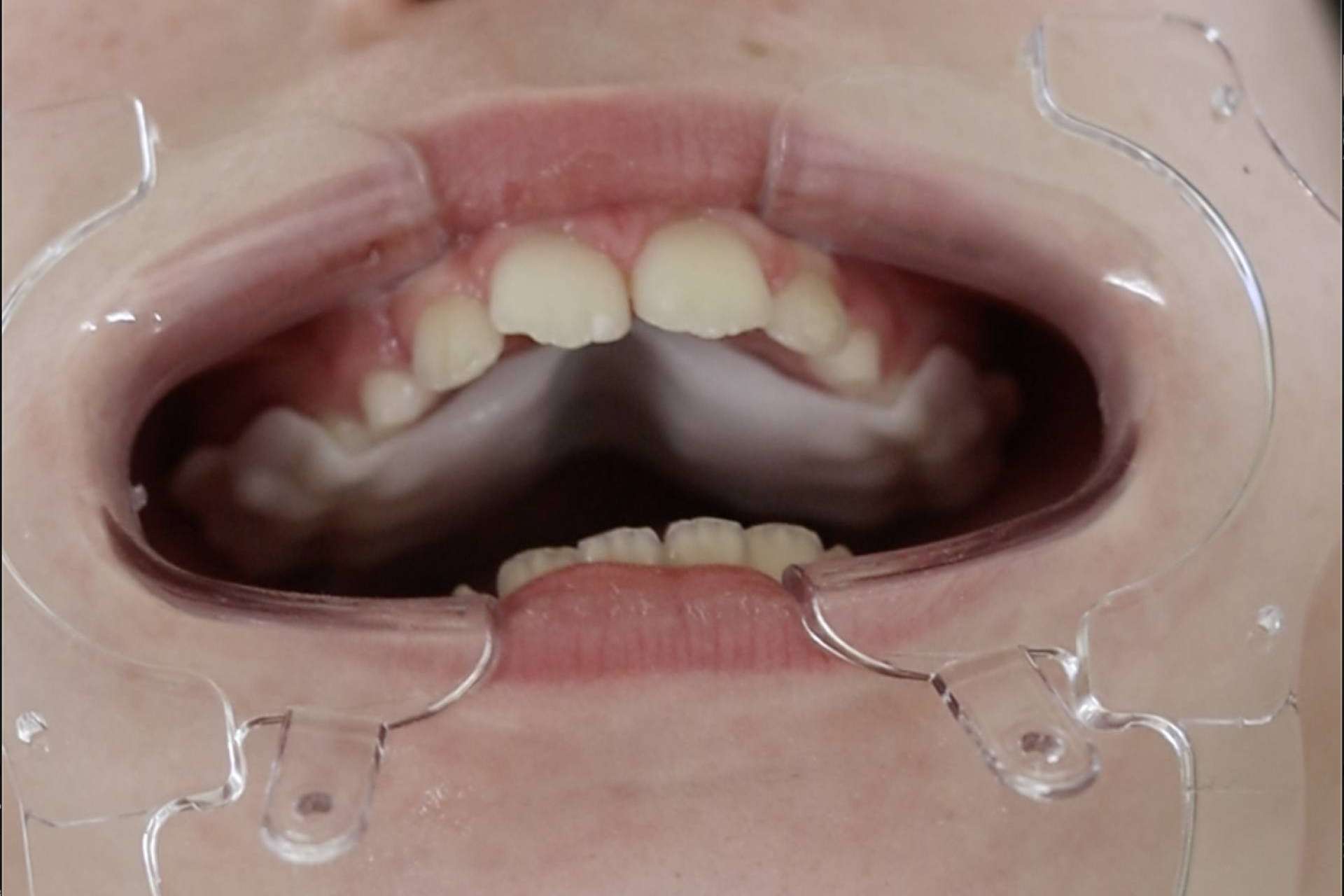 Smart Aligner Services da la bienvenida al Palatal Expander en su evento ‘Expansión Dental y esquelética’