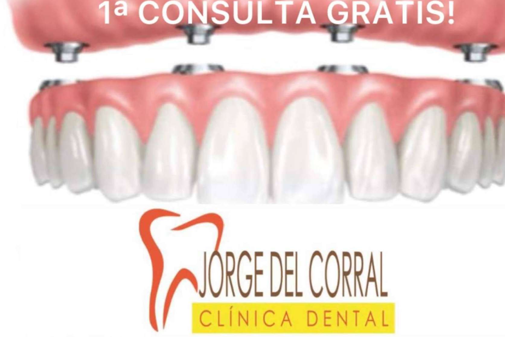 La solución definitiva en implantes dentales está en Clínica Dental Jorge del Corral La solución definitiva en implantes dentales está en Clínica Dental Jorge del Corral