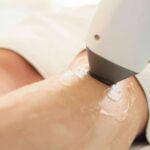 Depilación láser y sensibilidad; una perspectiva clara y objetiva