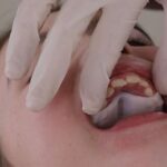Smart Aligner Services, precursor en Europa del primer evento sobre Invisalign Palatal Expander
