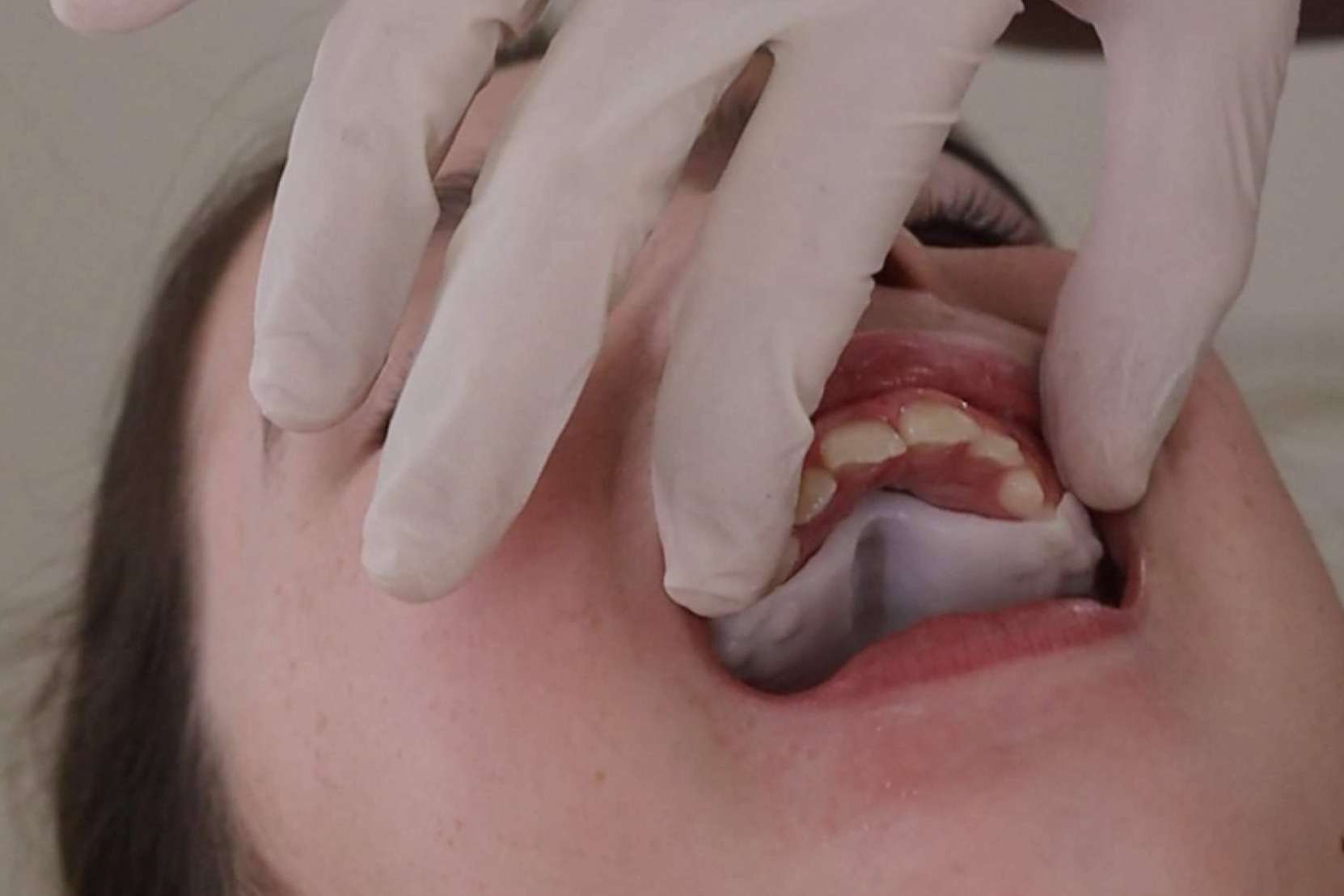 Smart Aligner Services, precursor en Europa del primer evento sobre Invisalign Palatal Expander Smart Aligner Services, precursor en Europa del primer evento sobre Invisalign Palatal Expander