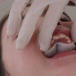 Smart Aligner Services, Pioneer in Europe’s First Event on Invisalign Palatal Expander