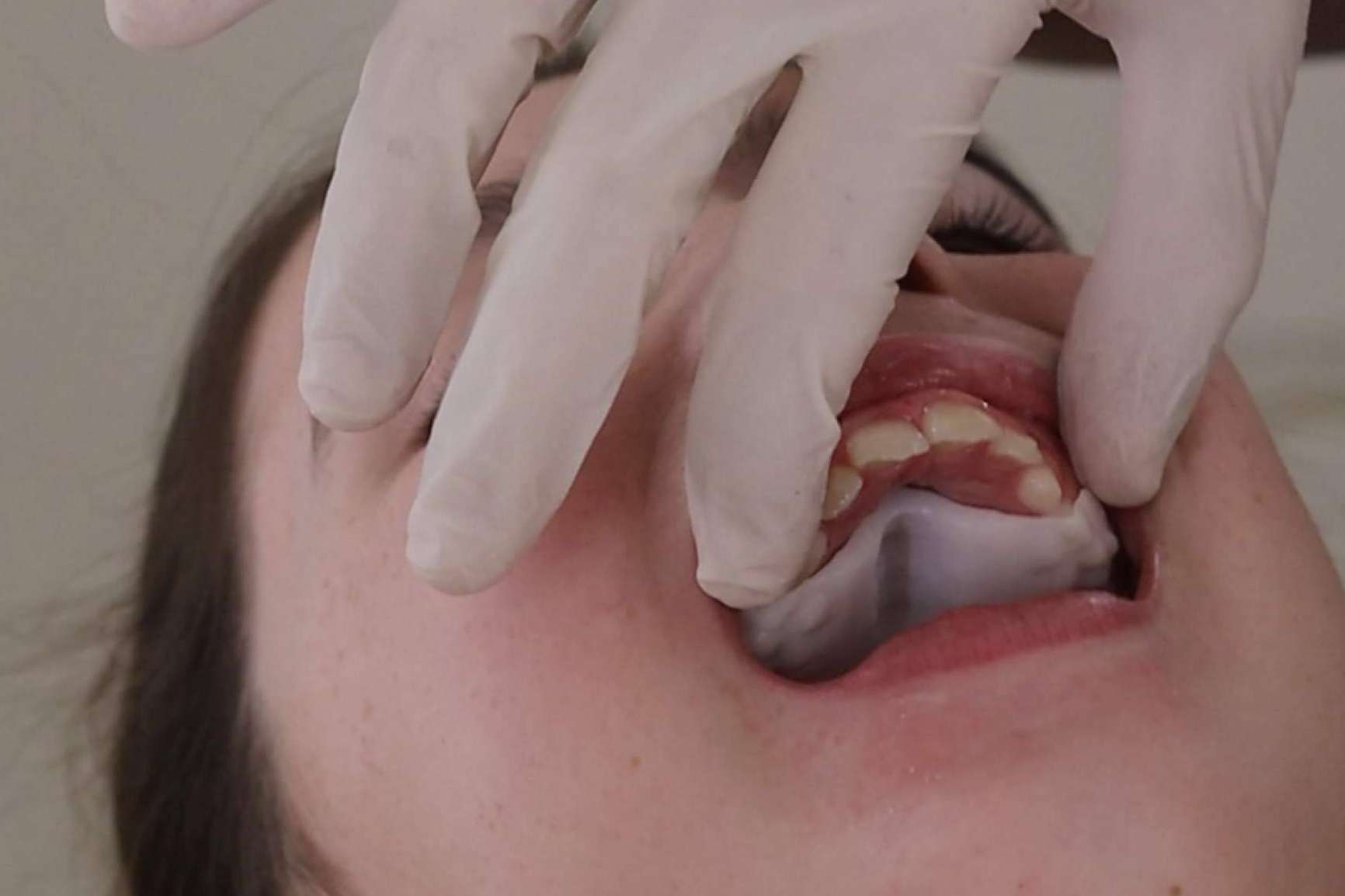 Smart Aligner Services, Pioneer in Europe’s First Event on Invisalign Palatal Expander Smart Aligner Services, Pioneer in Europe’s First Event on Invisalign Palatal Expander