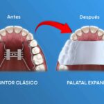 Doctores murcianos lideran la revolución en ortodoncia con expansores plásticos innovadores