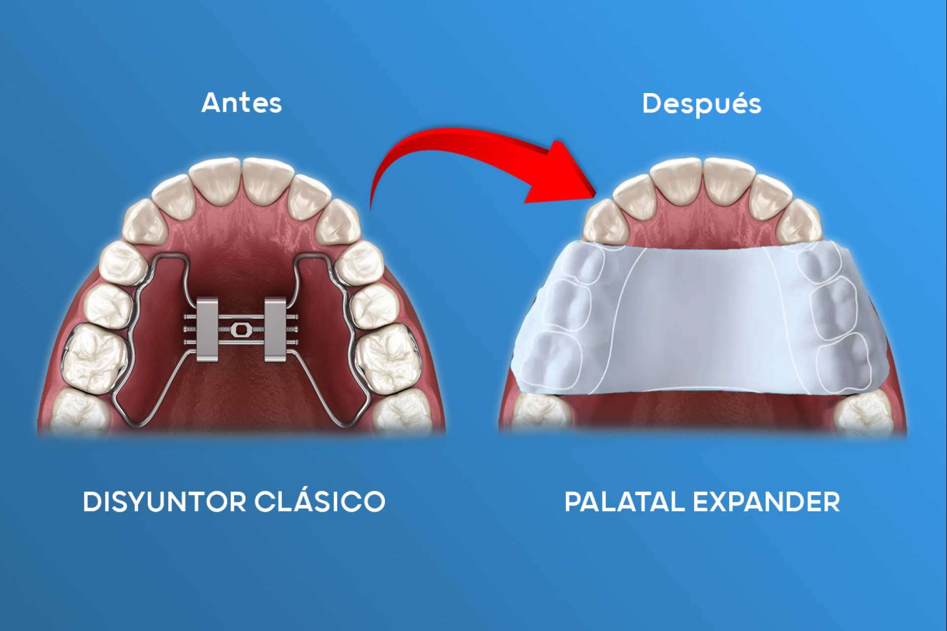 Doctores murcianos lideran la revolución en ortodoncia con expansores plásticos innovadores Doctores murcianos lideran la revolución en ortodoncia con expansores plásticos innovadores