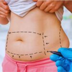 Qué es la lipo Vaser y cómo se diferencia de la liposucción tradicional