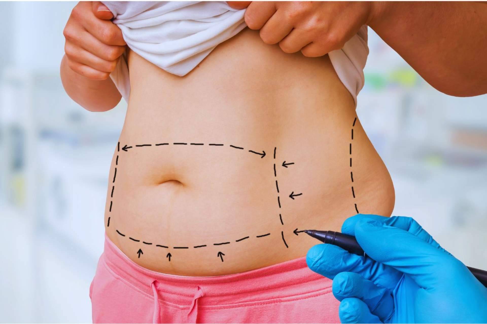 Qué es la lipo Vaser y cómo se diferencia de la liposucción tradicional
