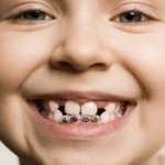 El Centre Dental Francesc Macià explica en qué consiste un tratamiento de ortodoncia infantil y sus posteriores beneficios El Centre Dental Francesc Macià explica en qué consiste un tratamiento de ortodoncia infantil y sus posteriores beneficios