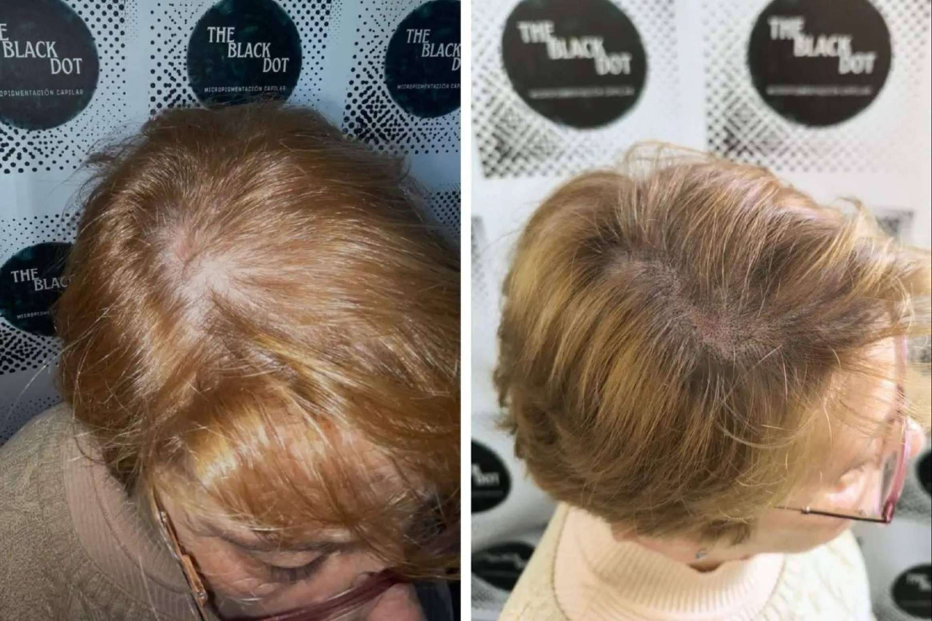 Mejorar la confianza con la Micropigmentación Capilar; Descubrir The Black Dot en Murcia Mejorar la confianza con la Micropigmentación Capilar; Descubrir The Black Dot en Murcia