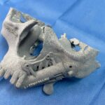 Los implantes cigomáticos mediante cirugía guiada son una solución segura para la rehabilitación de maxilares atróficos o secuelas de tumores