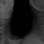 Tratamiento de la hernia discal cervical