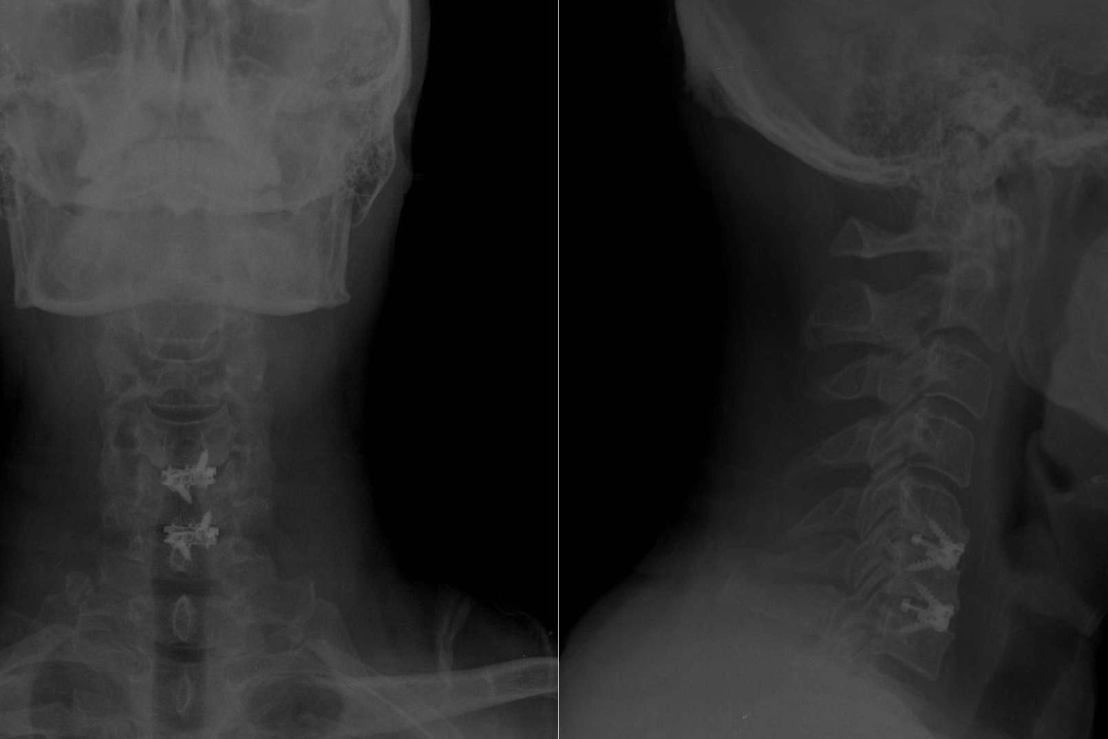 Tratamiento de la hernia discal cervical Tratamiento de la hernia discal cervical