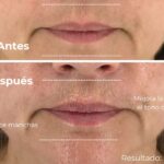 Novedad mundial; Lifting 4D llega para transformar el rejuvenecimiento facial sin procedimientos invasivos