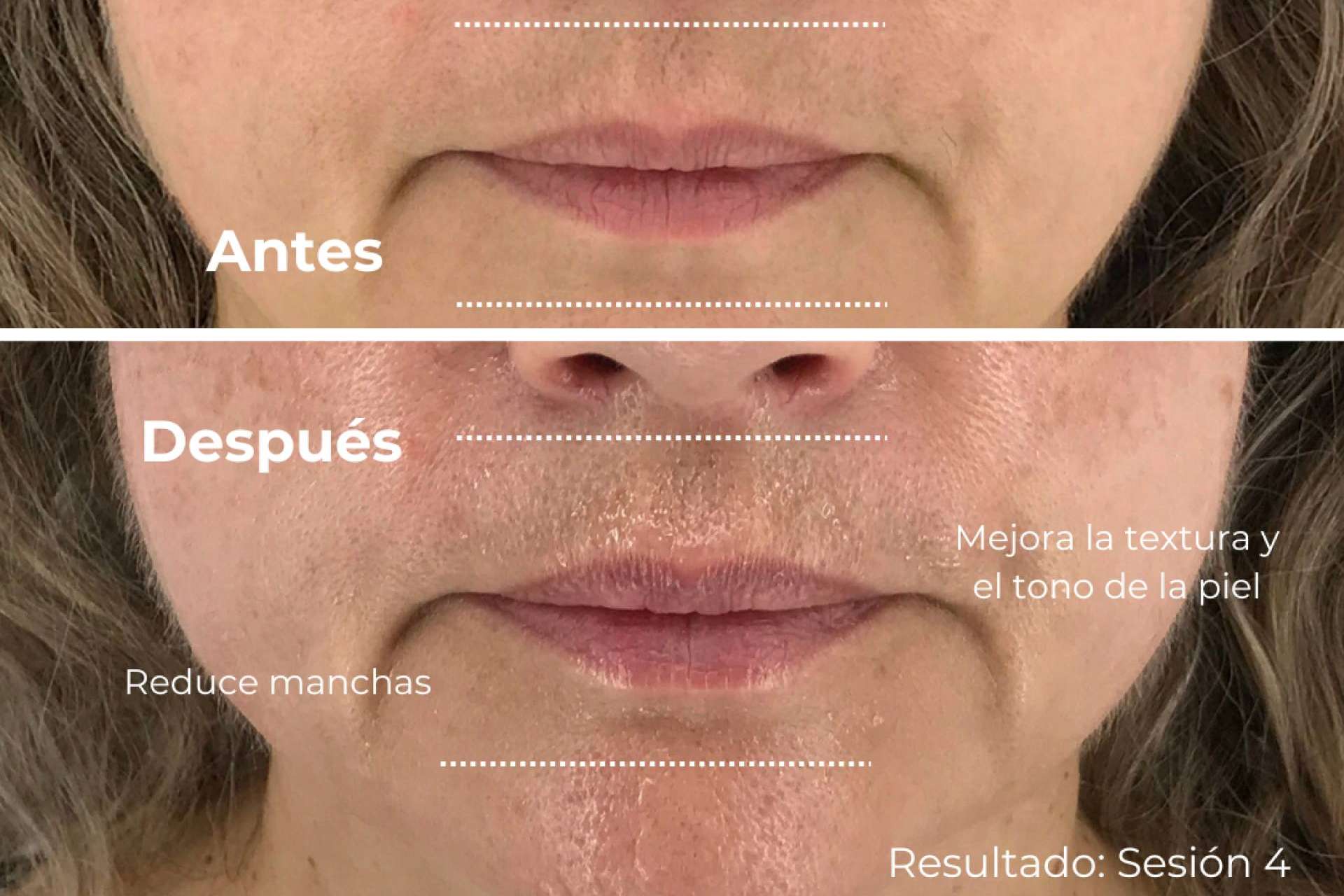 Novedad mundial; Lifting 4D llega para transformar el rejuvenecimiento facial sin procedimientos invasivos