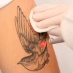 360Clinics revoluciona la eliminación de tatuajes con picolaser, un método eficaz y seguro