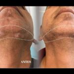 La Dra. Janeth Arévalo implementa terapia combinada para el tratamiento del vitiligo en Clínica God Bless en Loja