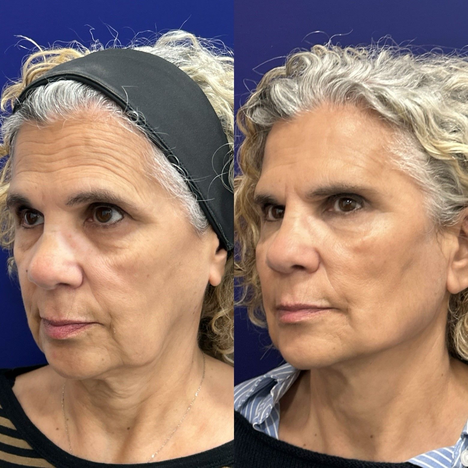 Global Face: nuevo protocolo integral del Dr. Ángel Martín para la recuperación de estructuras faciales, de la firmeza y elasticidad dérmica