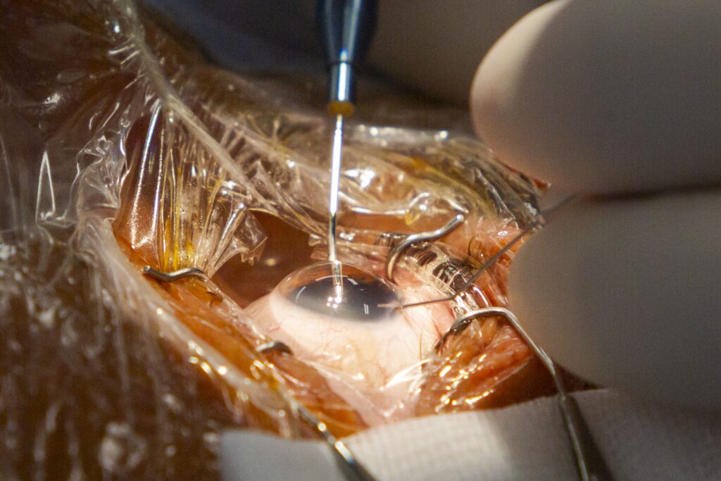 El codirector de FacoElche se somete en directo a la implantación bilateral de una lente diseñada con IA