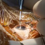 El codirector de FacoElche se somete en directo a la implantación bilateral de una lente diseñada con IA