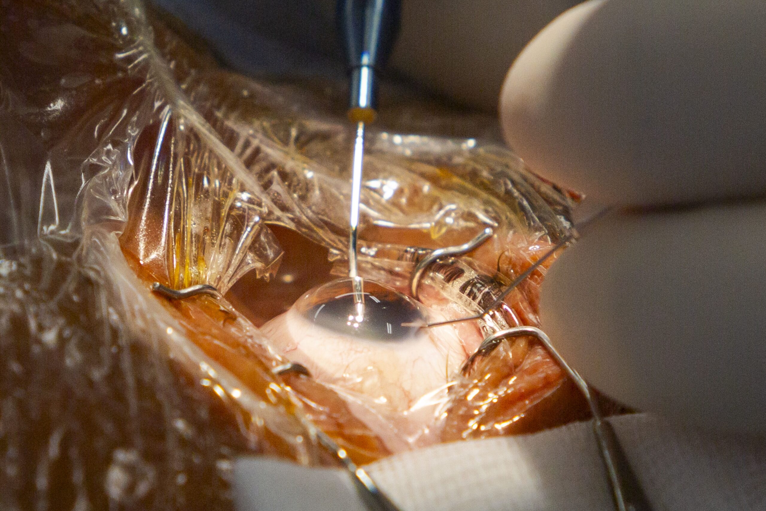 El codirector de FacoElche se somete en directo a la implantación bilateral de una lente diseñada con IA