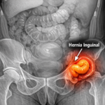 Dr. José Luis Elósegui: “Uno de cada cuatro hombres desarrollará una hernia inguinal a lo largo de su vida” Dr. José Luis Elósegui: “Uno de cada cuatro hombres desarrollará una hernia inguinal a lo largo de su vida”