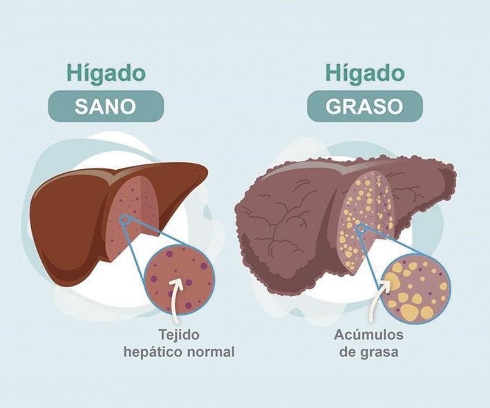 Dr. Juan Arenas, jefe servicio Aparato Digestivo:”Hoy disponemos de un nuevo medio no invasivo para detectar la fibrosis hepática”