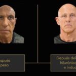 La otra cara del éxito de los GLP-1: el nuevo reto de la medicina estética